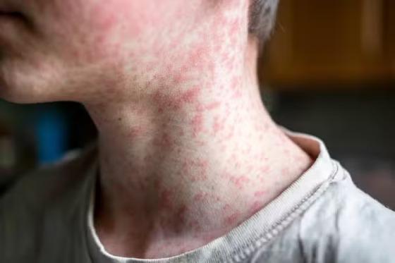 Surto de sarampo na Bolívia preocupa o Brasil. Manchas no corpo estão entre os sintomas da doença.