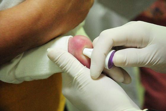 O Teste do Pezinho ou Triagem Neonatal é a forma mais efetiva e precoce de detectar a anemia falciforme